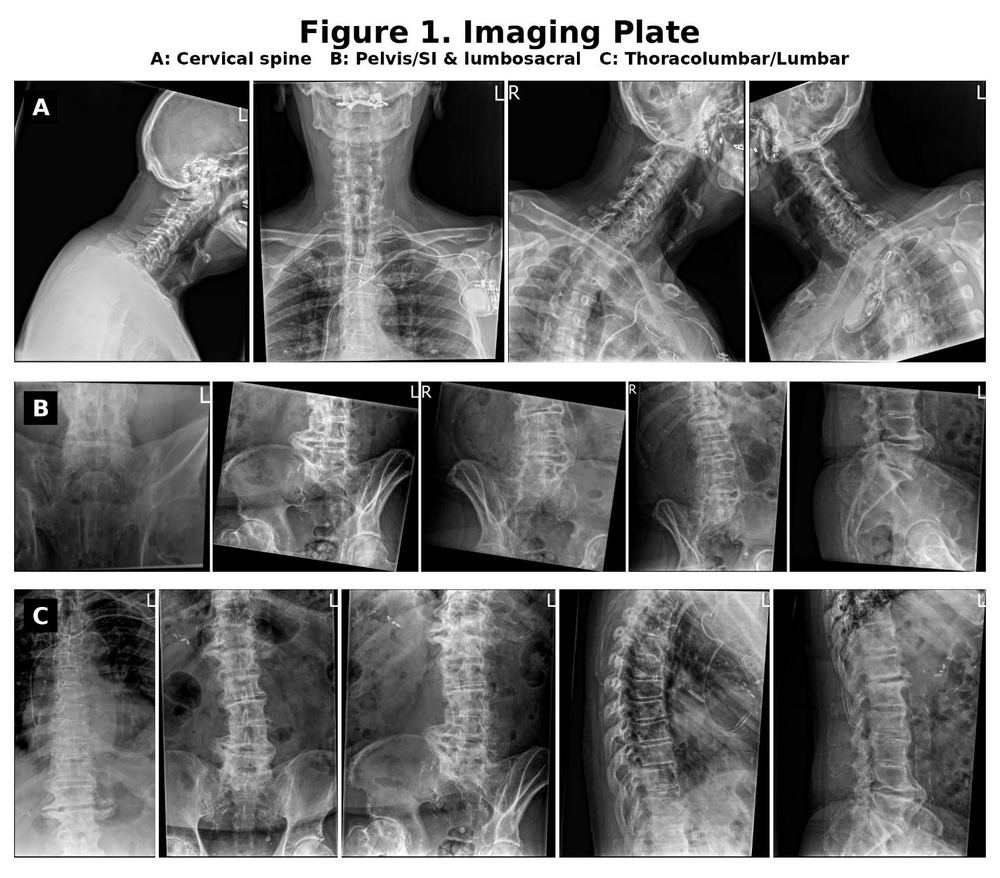 Protected: Podcast Episode: DISH vs Ankylosing Spondylitis